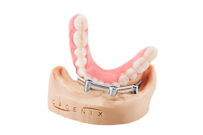 AccuFrame Overdenture 1